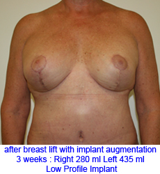 plastic-surgery-breast-lift-augmentation